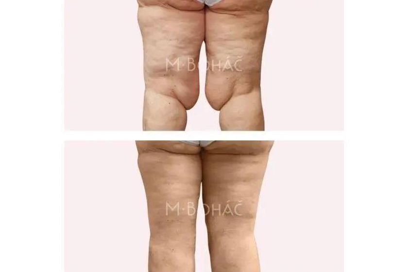 Liposukcia pred a po - 806084