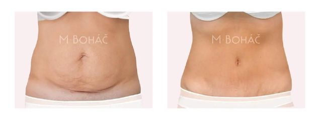 Abdominoplastika (Operácia brucha)