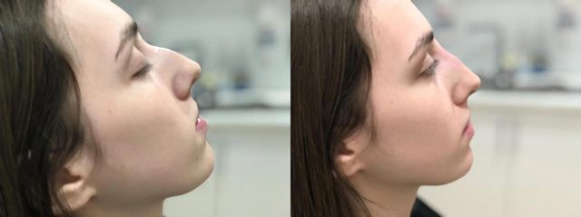Klinika ENVY - Korekcia nosa aplikáciou kyseliny hyalurónovej