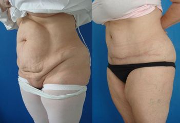 abdominoplastika
