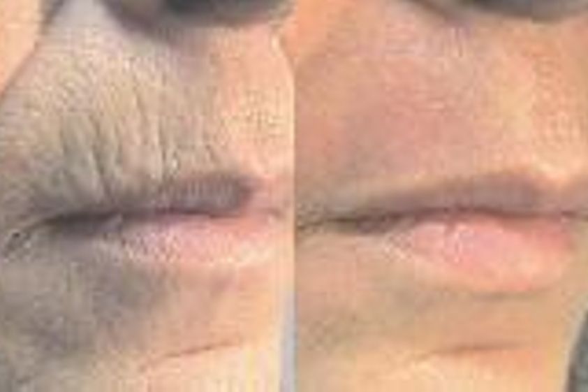 Anti aging pred a po - 803512