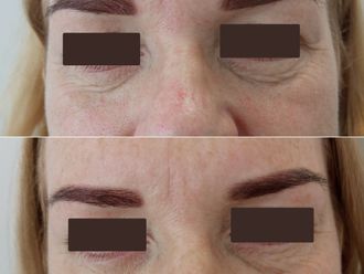 Anti aging pred a po - 879855