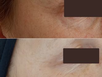 Anti aging pred a po - 879856