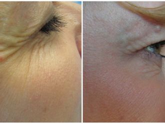 Botulotoxín pred a po - 856960