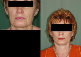 facelift1zpredupred