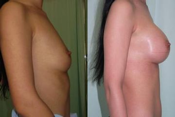 implantaty1predzboku