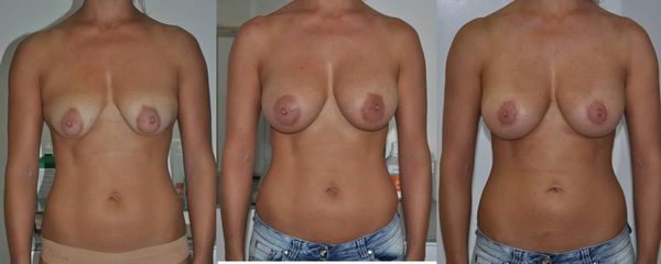 Augmentácia a modelácia prsníkov s Nagor implantátmi
