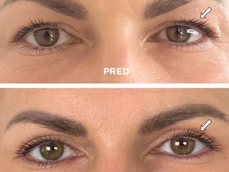 Blefaroplastika pred a po - 878930