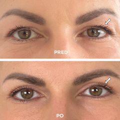 Blefaroplastika horných viečok