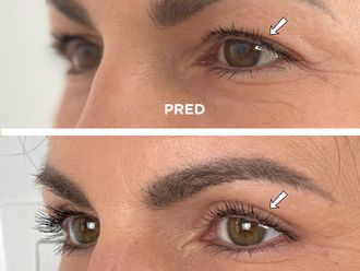 Blefaroplastika pred a po - 878931