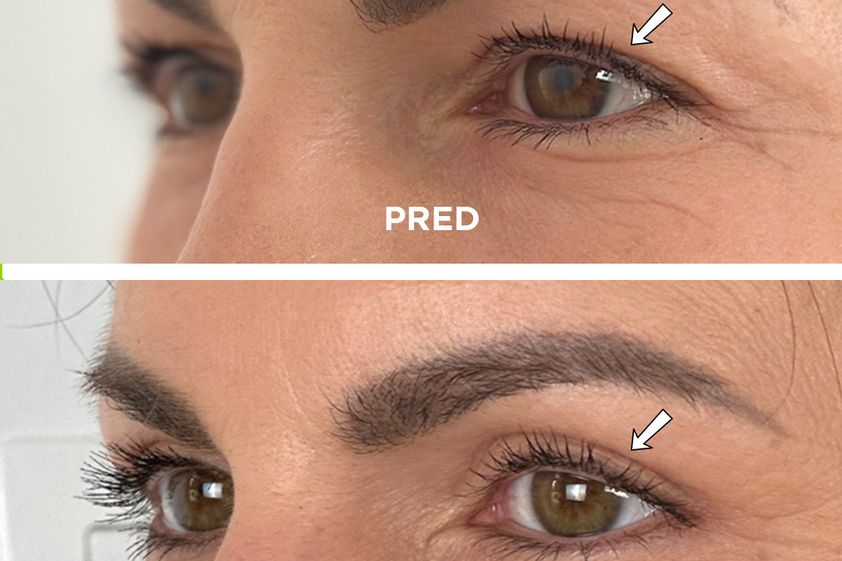 Blefaroplastika pred a po - 878931
