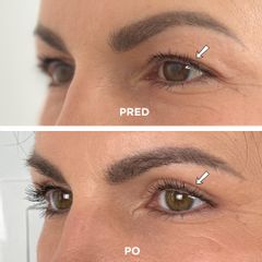 Blefaroplastika horných viečok