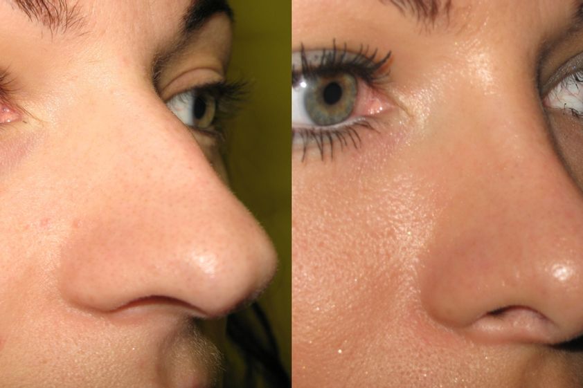 Rhinoplastika pred a po - 831876