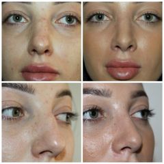 Rhinoplastika - MUDr. Marián Sičák PhD.