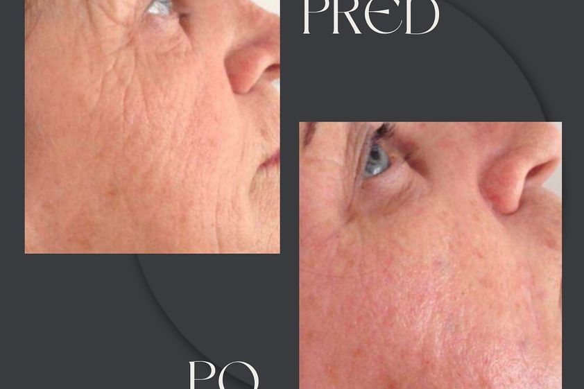 Mezoterapia pred a po - 864358