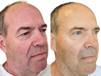 Blefaroplastika pred a po - 877569