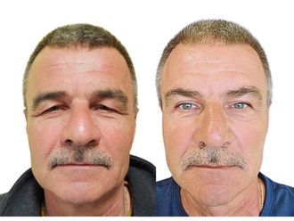 Blefaroplastika pred a po - 877570