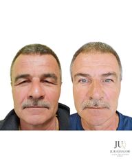 Operácia horných viečok