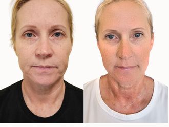 Blefaroplastika pred a po - 877571