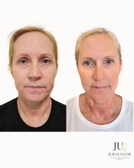 Operácia horných viečok