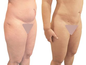 Liposukcia pred a po - 877573