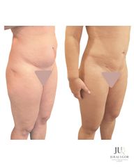 Liposukcia brucha a stehien
