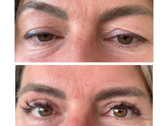 Blefaroplastika pred a po - 880862