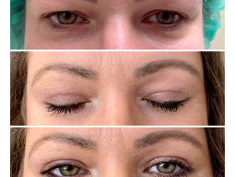 Blefaroplastika pred a po - 880863