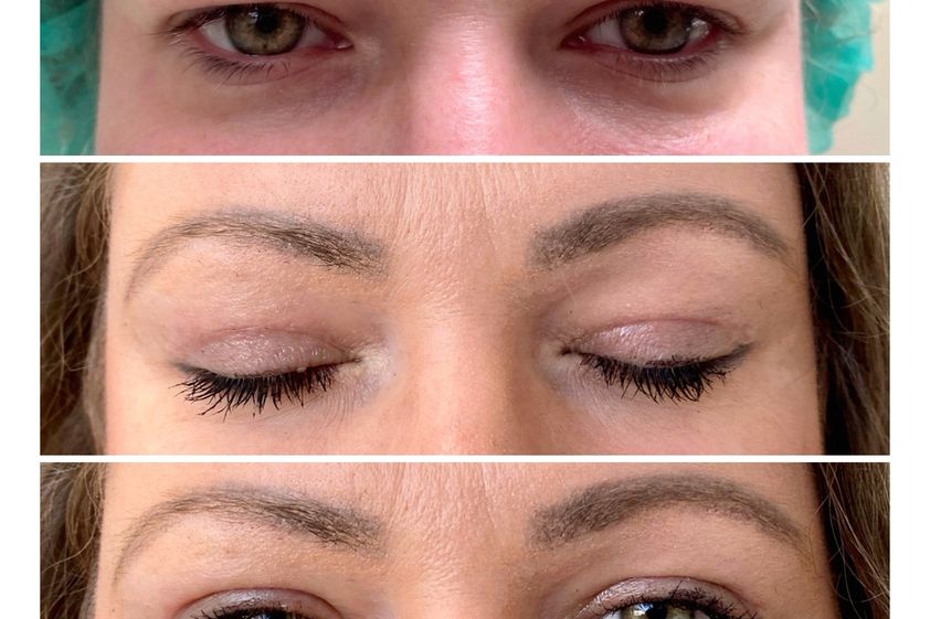 Blefaroplastika pred a po - 880863