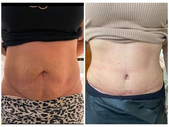 Abdominoplastika pred a po - 880868