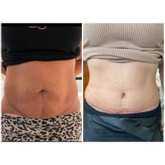 Abdominoplastika MUDr. Lea Šimšić