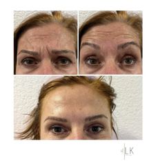 Botox MUDr. Lea Šimšić