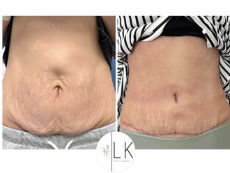 Abdominoplastika pred a po - 880870