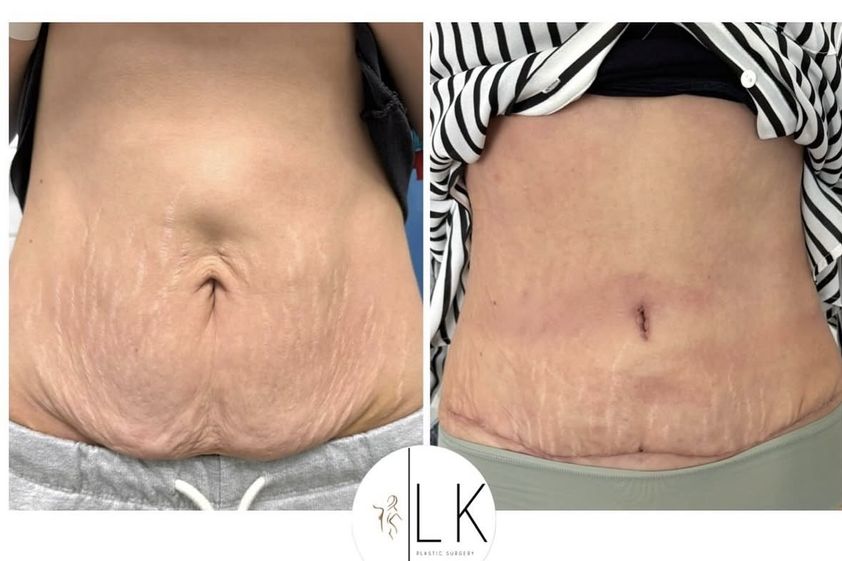 Abdominoplastika pred a po - 880870