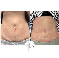 Abdominoplastika MUDr. Lea Šimšić