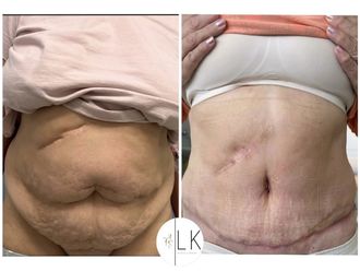 Abdominoplastika pred a po - 880871