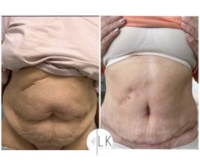 Abdominoplastika MUDr. Lea Šimšić