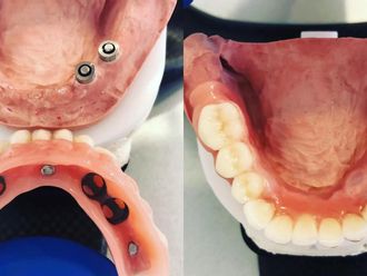 Zubné implantáty pred a po - 804925