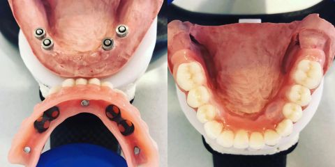 Zubné miniimplantáty - podpora dolnej celkovej protézy