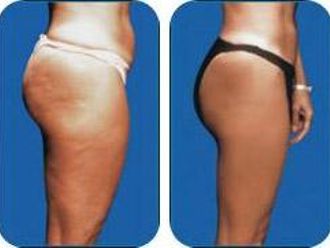 Karboxyterapia pred a po - 803906