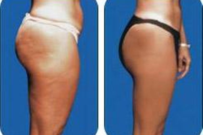 Karboxyterapia pred a po - 803906