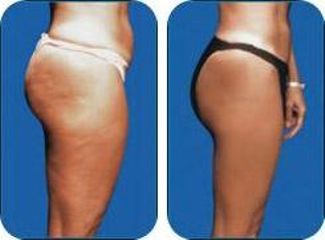 laser karboxyterapia
