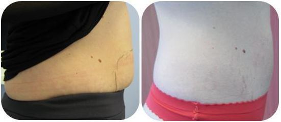 laserova liposukcia pred