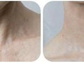 Mezoterapia - 803925