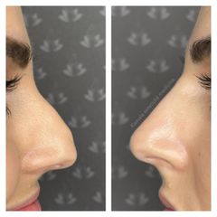 Modelácia nosa - Kamala estetická klinika