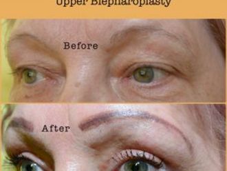 Operácia očných viečok (Blepharoplastika) - 837666