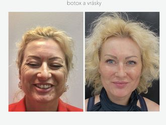 Botulotoxín pred a po - 856051