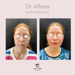 Kyselina hyaluronová - The Care Clinic