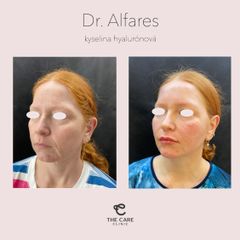 Kyselina hyaluronová - The Care Clinic