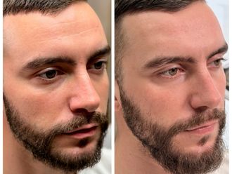 Botulotoxín pred a po - 879192